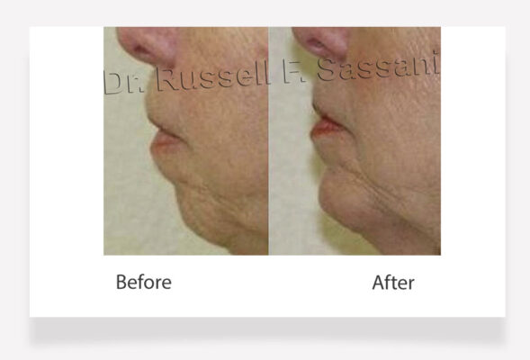 Female chin surgery results