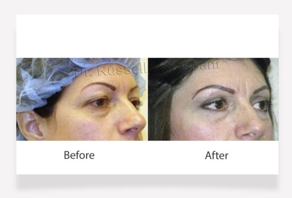 Eyelid surgery results on female patient