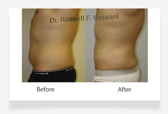 Liposuction results on male patient