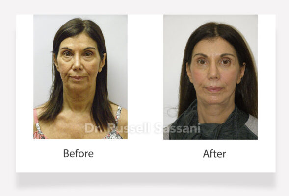 Before and after results of a face lift done on an older female patient