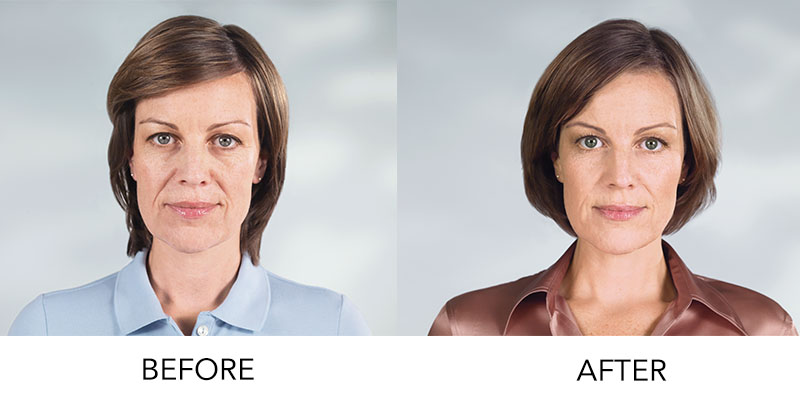 Before and after results on a female patient