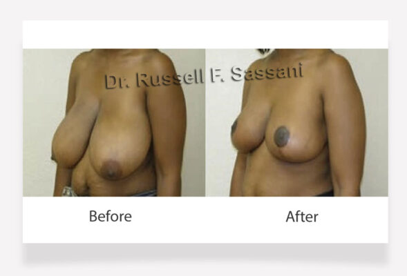 Breast reduction results on female patient