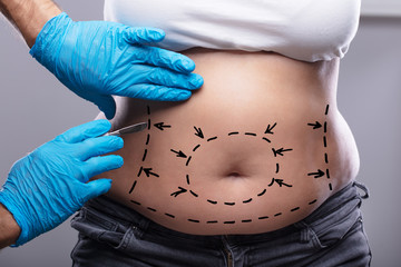A doctor making markings on a female patient for liposuction procedure