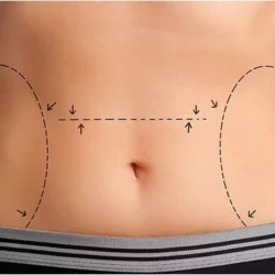 Liposuction procedure in Fort Lauderdale